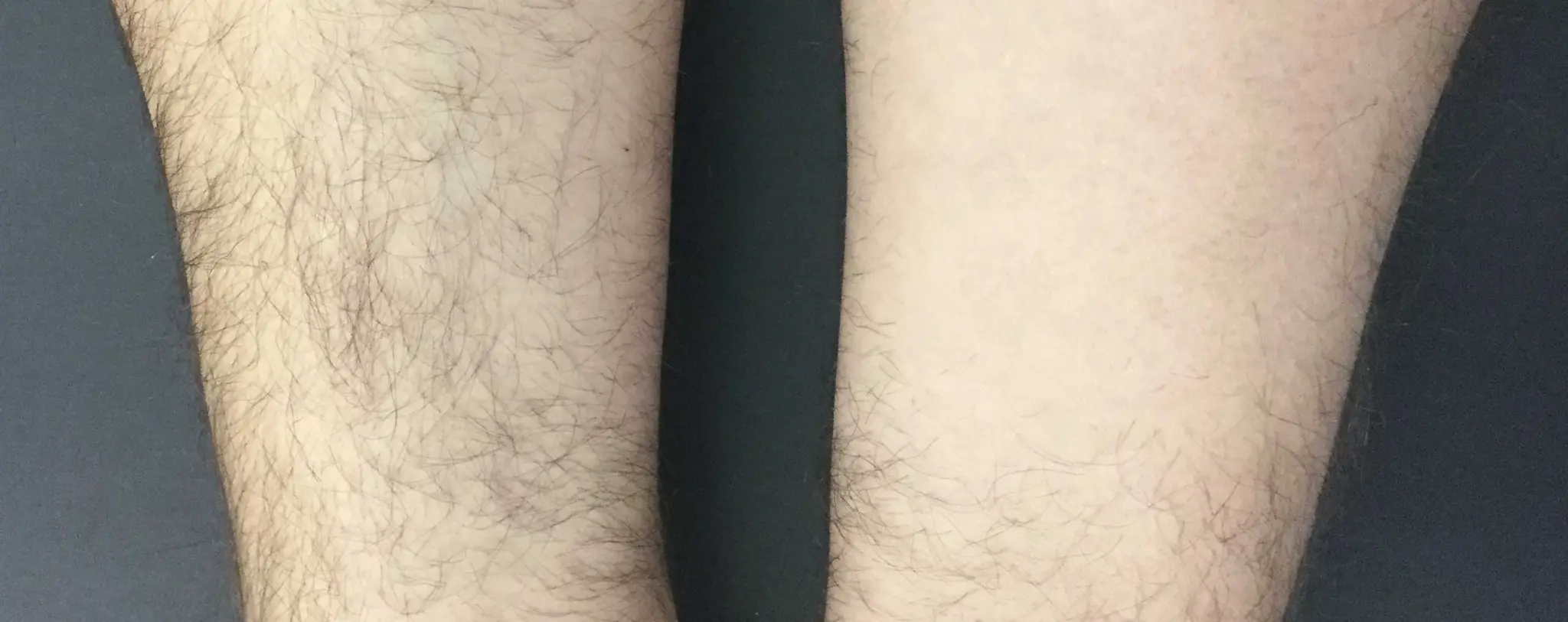 Laser Hair Removal result 2