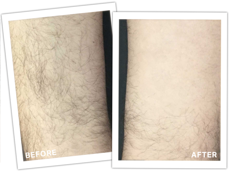 Laser Hair Removal result 1