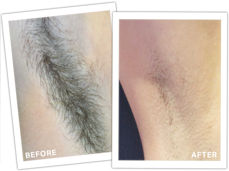 Laser Hair Removal result 3